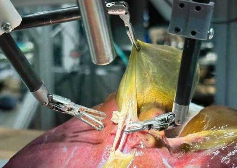أول عملية من نوعها في السعودية.. روبوت جراحي يعيد مريضًا للمشي خلال ساعة من جراحة العمود الفقري